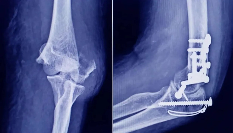 ANMAT investiga un tornillo traumatológico trucho hallado en una ortopedia