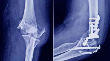 ANMAT investiga un tornillo traumatológico trucho hallado en una ortopedia