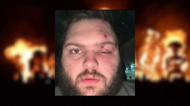 Un joven resultó herido en la quema de un muñeco y perdió la visión de un ojo