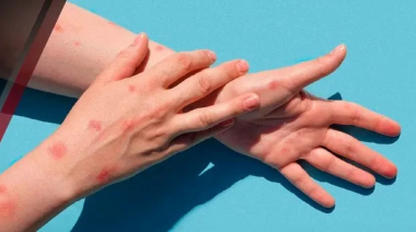 Confirmaron un caso de viruela de mono en Argentina: es más contagioso y severo